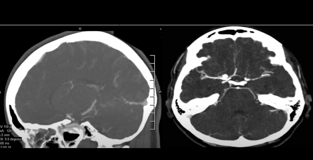 Presillamiento De Aneurisma Del Segmento Comunicante&nbsp;Posterior