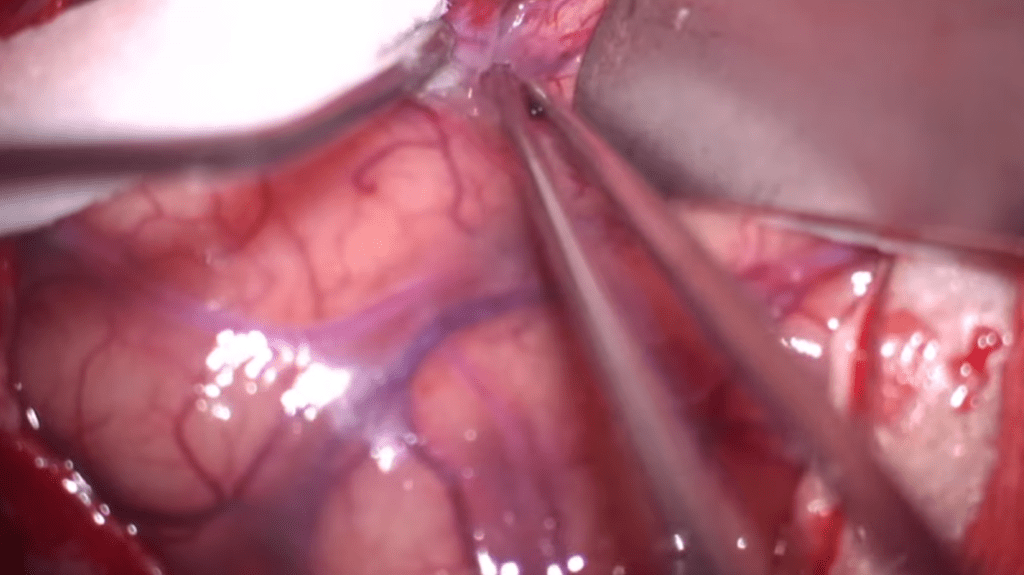 Clipaje de Múltiples Aneurismas de la Arteria&nbsp;Carótida