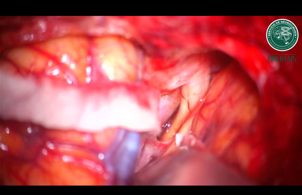 Presillamiento de aneurisma del complejo comunicante&nbsp;anterior