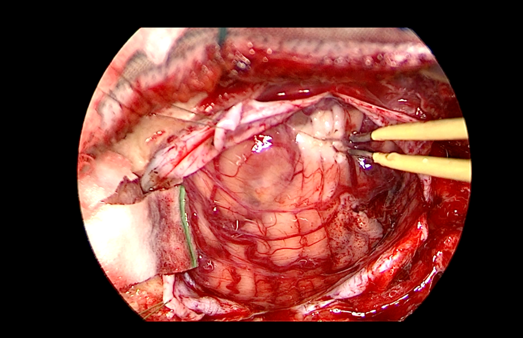 Tumor de hemisferio cerebeloso&nbsp;derecho.