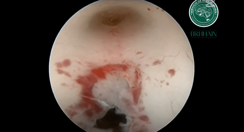 Fenestración del piso del tercer ventrículo por tecnica&nbsp;endoscopica