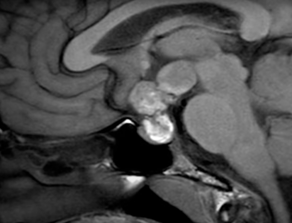 Abordaje endonasal endoscópico para el tratamiento de un craneofaringioma