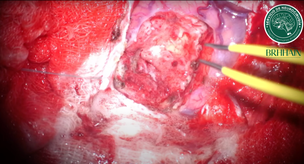 Meningioma de la convexidad